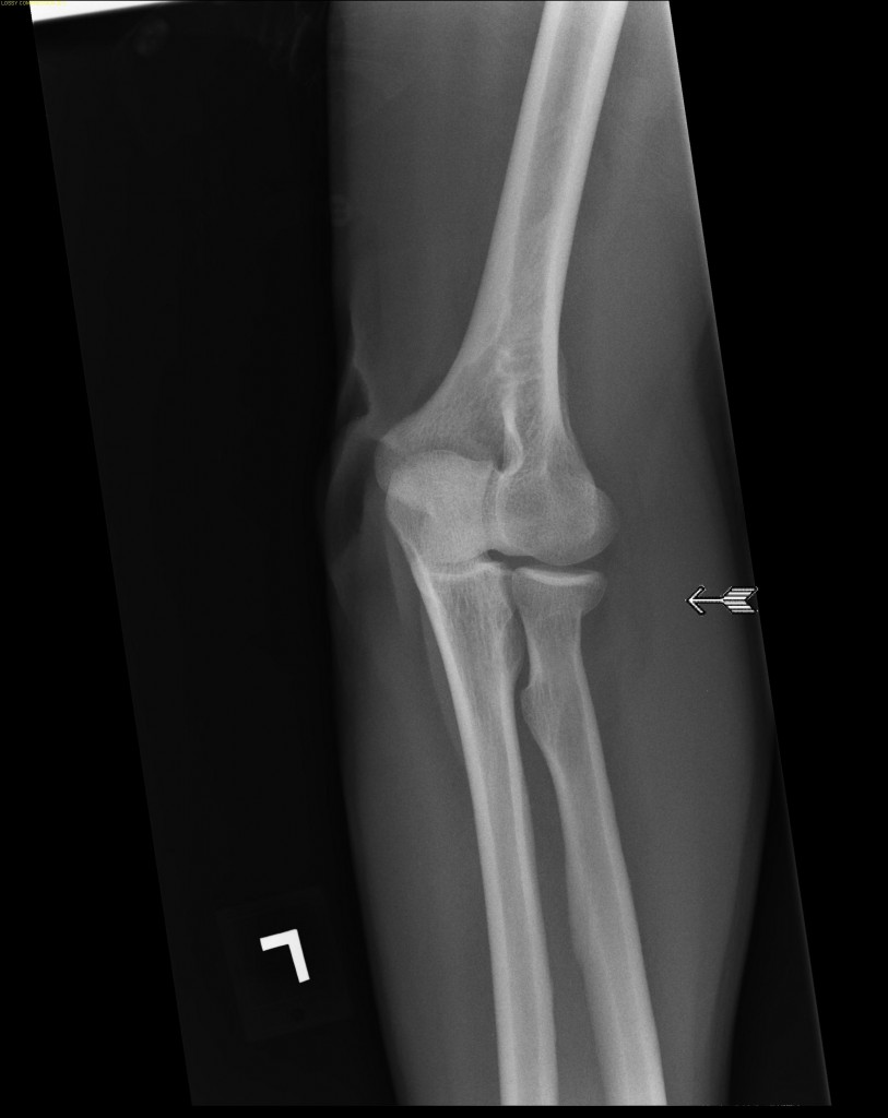 radial_head_fracture_010215